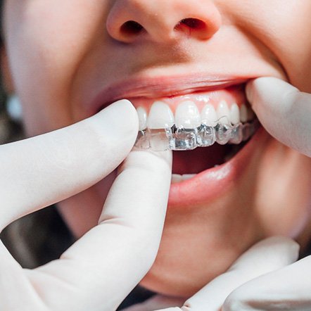 Dentist putting clear aligner on patient