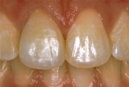 Close up of smile with lighter teeth thanks to dental crowns
