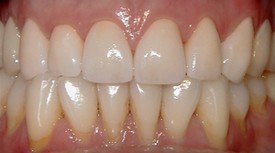 Close up of brighter teeth