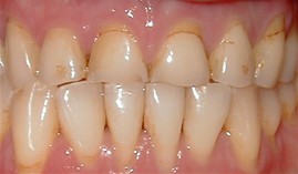 Close up of yellowed teeth
