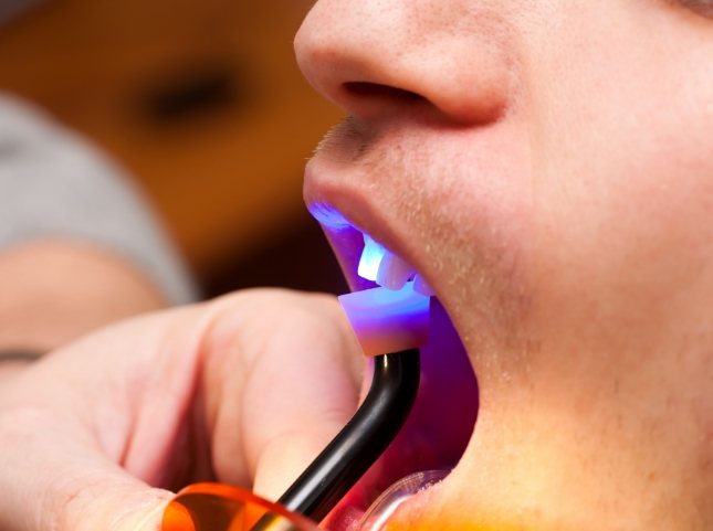 Close up of dental patient receiving direct bonding on front upper tooth