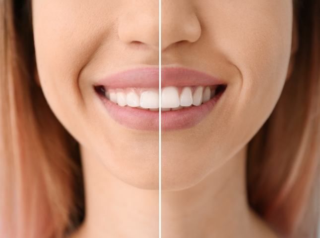 Close up of woman smiling before and after fixing uneven gumline