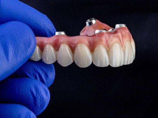 Gloved hand holding a set of implant dentures