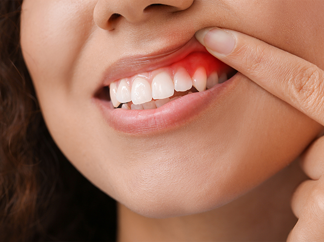 Close up of person pointing to red spot in their gums before gum disease treatment in San Ramon