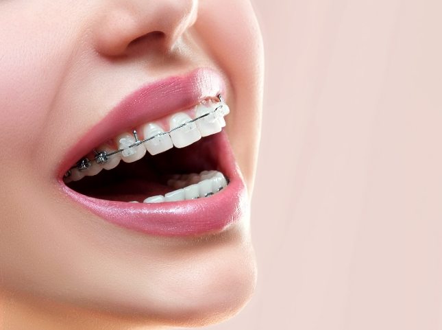 Close up of a person smiling with clear ceramic braces