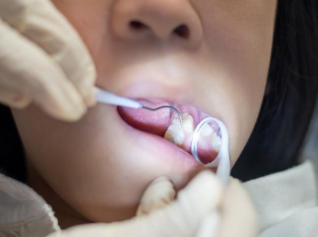 Close up of a child receiving dental sealants from their San Ramon pediatric dentist