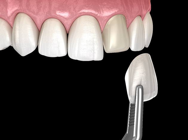 Illustration of veneer being placed on tooth