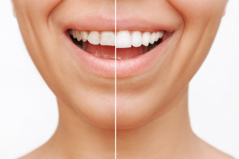 Before and after cosmetic dentistry