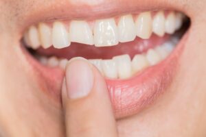 Person pointing to their chipped tooth