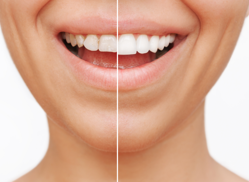 Close up of woman's smile, half natural teeth, half veneers