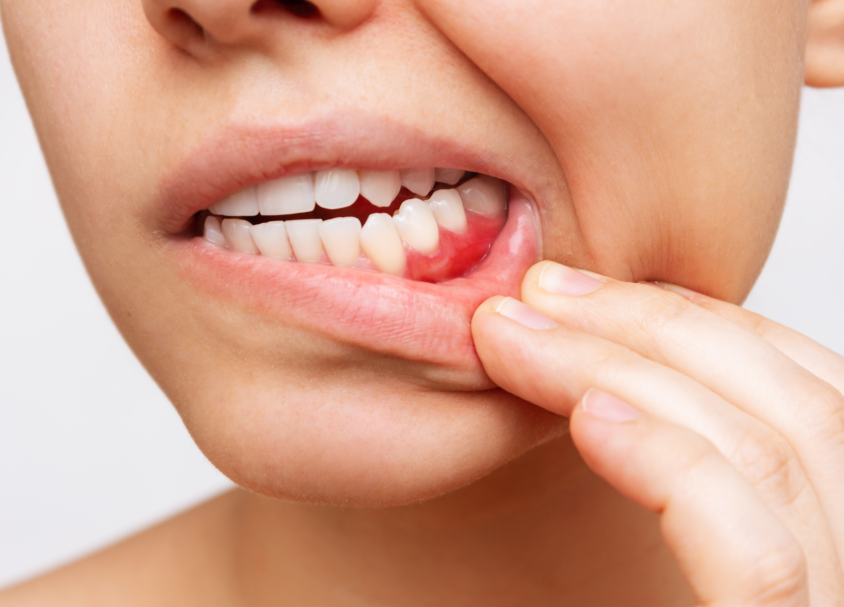 Close up of woman's mouth with inflamed gums