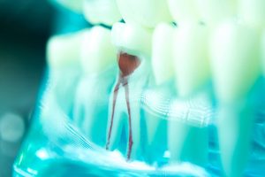 Closeup of damaged tooth root in transparent jaw